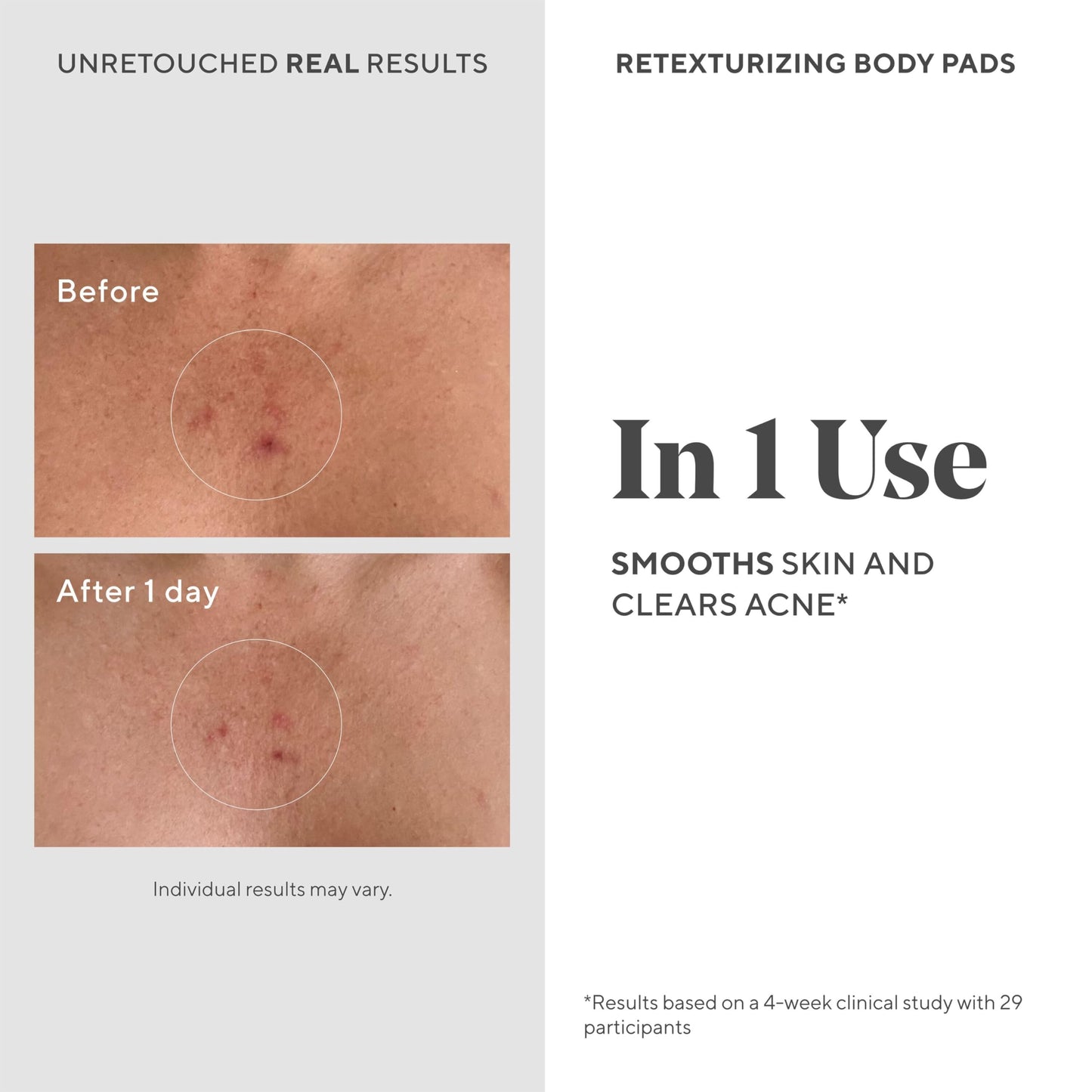Murad Retexturizing Body Pads – Acne-Fighting Exfoliating Pads with Azelaic, Salicylic, and Glycolic Acid for Acne Breakouts, Smoothing KP Bumps, and Soothing Aggravated Skin – 45 Pads