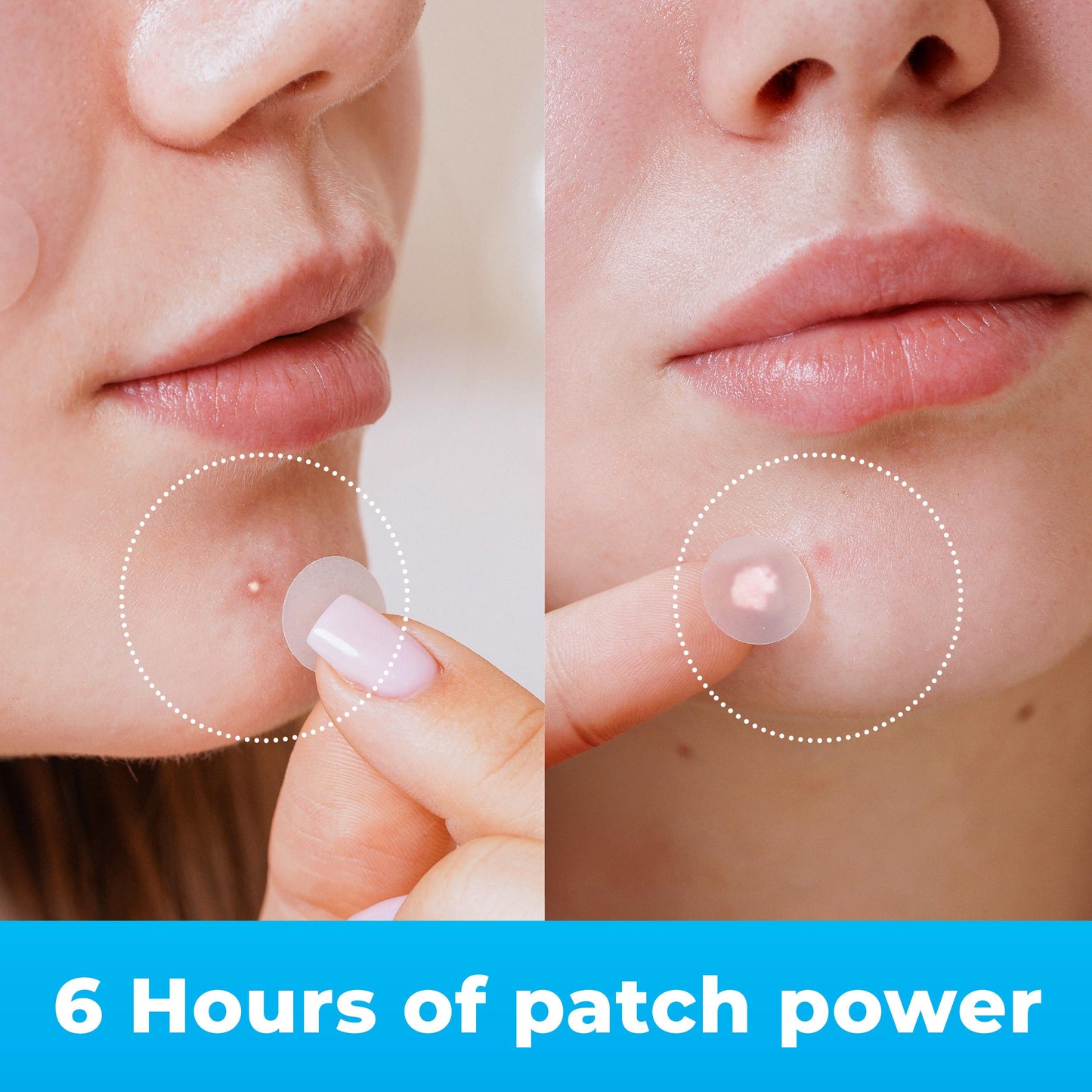 PatchRx Pimple Patches for Face (120 Patches), Hydrocolloid Acne Patches with Tea Tree Oil, Pimple Patch Pimple Stickers - Hydrocolloid Patch Acne Dots - Acne Pimple Patches For Face - Zit Patches