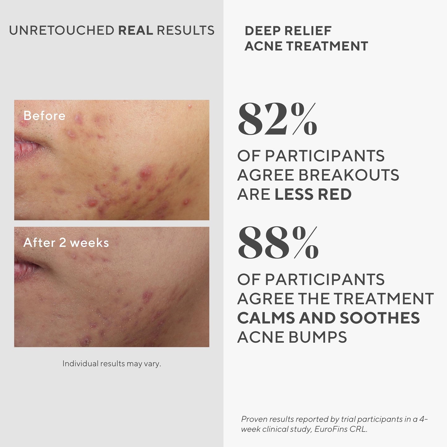 Murad Deep Relief Acne Treatment with 2% Salicylic Acid - Deep, Painful Acne Spot Treatment for Face – Redness Relief, Fast Acting Blemish Serum, Soothing Breakout Treatment - 1Fl Oz