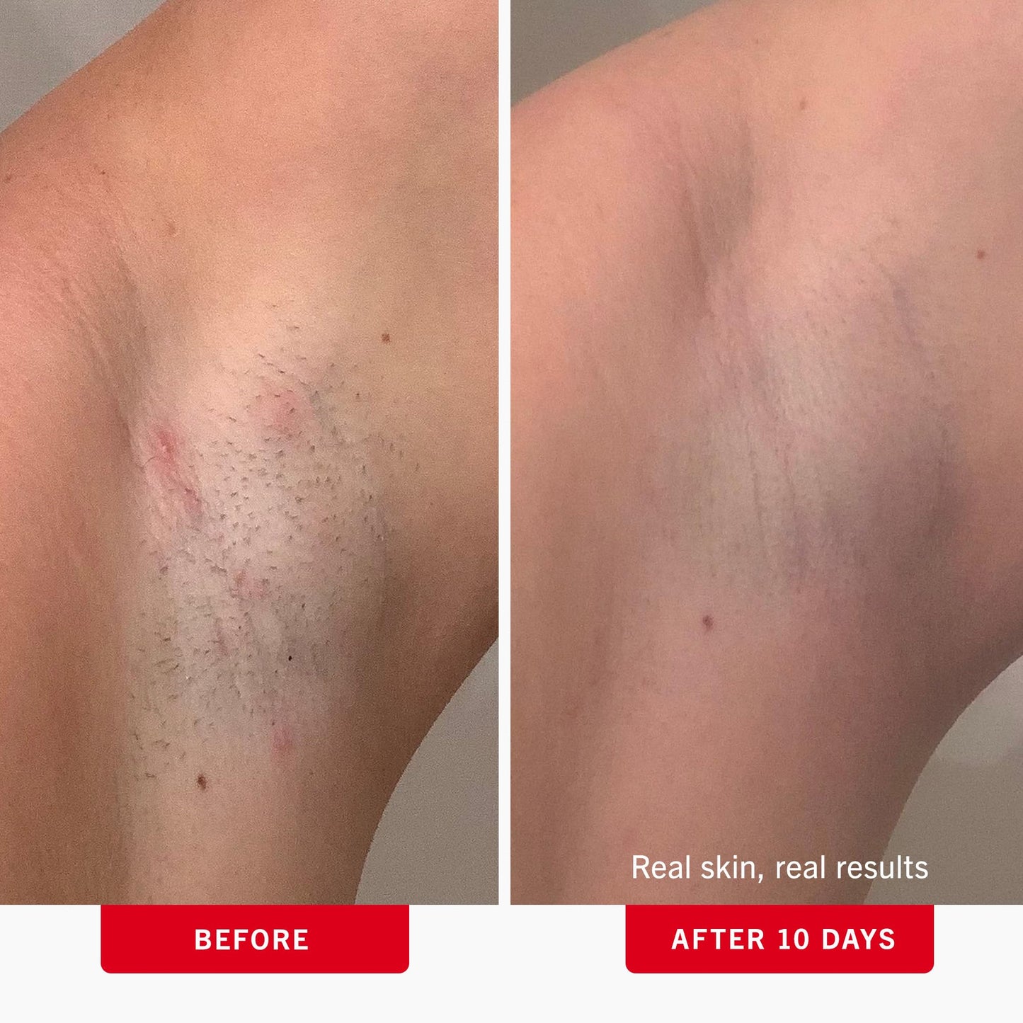 First Aid Beauty - Ingrown Hair Pads with BHA + AHA - Aftershave Treatment Pads to Help Prevent Razor Bumps for Men & Women - Exfoliate Underarms & Bikini Area - Compostable for Daily Use - 28 Pads